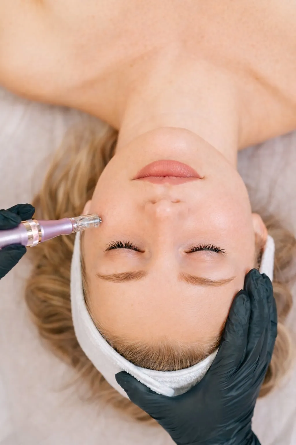 Microneedling – Beauty by Rezi